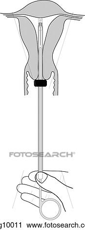 Clip Art - Intrauterine Devices, insertion, step 2. Fotosearch