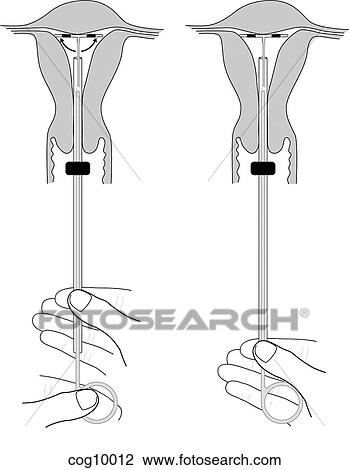 Intrauterine Devices, insertion, step 3 View Large Illustration Drawing - Intrauterine Devices, insertion, step 3. Fotosearch