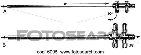 Irrigator/aspirator, trumpet valved View Large Illustration Stock Illustration - Irrigator/aspirator, trumpet valved. Fotosearch