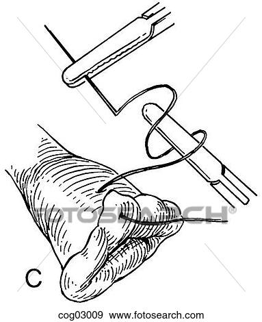 Laparoscopic knot tying, part 2 View Large Illustration Stock Illustration - Laparoscopic knot tying, part 2. Fotosearch