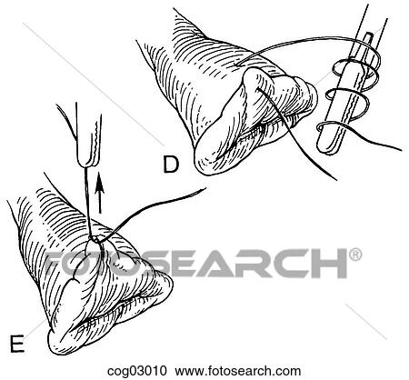Laparoscopic knot tying, part 3 View Large Illustration Clipart - Laparoscopic knot tying, part 3. Fotosearch