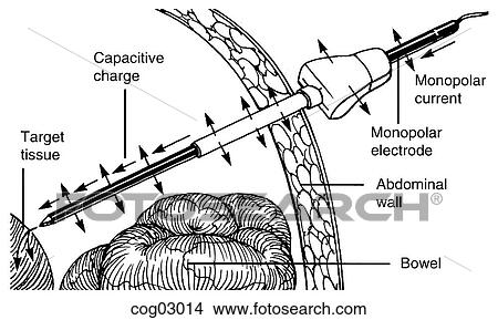 Laparoscopy, current diversion, step 1 View Large Illustration Stock Illustration - Laparoscopy, current diversion, step 1. Fotosearch