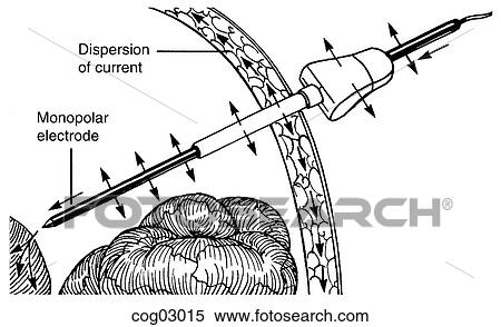 Stock Illustration - Laparoscopy, current diversion, step 2. Fotosearch