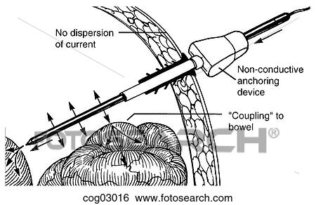 Laparoscopy, current diversion, step 3 View Large Illustration Stock Illustration - Laparoscopy, current diversion, step 3. Fotosearch