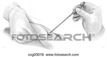 Laparoscopy, Verres needle insertion View Large Illustration Stock Illustration - Laparoscopy, Verres needle insertion. Fotosearch