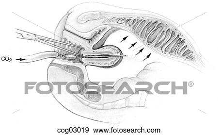 Stock Illustration - Laparoscopy, Verres needle insertion. Fotosearch