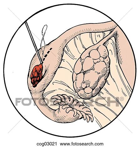 Clip Art - Microsurgery for ectopic pregnancy. Fotosearch