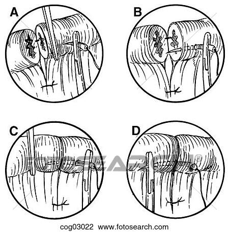 Microsurgery, knot tying, part 1 View Large Illustration Drawing - Microsurgery, knot tying, part 1. Fotosearch