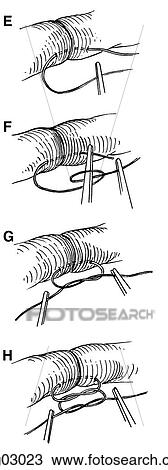 Drawing - Microsurgery, knot tying, part 2. Fotosearch