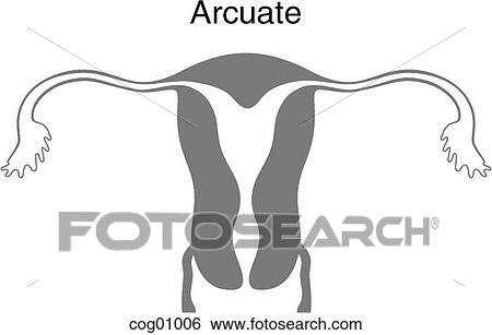 Stock Illustration - Mullerian duct anomaly, arcuate. Fotosearch