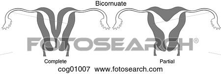 Stock Illustration - Mullerian duct anomaly, bicornuate. Fotosearch