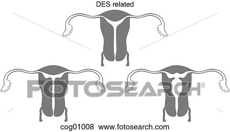 Stock Illustration - Mullerian duct anomaly, DES related. Fotosearch
