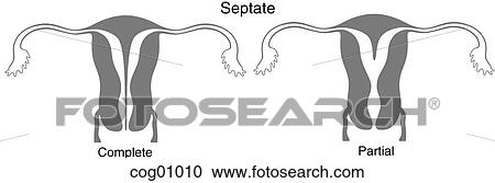 Clipart - Mullerian duct anomaly, septate. Fotosearch