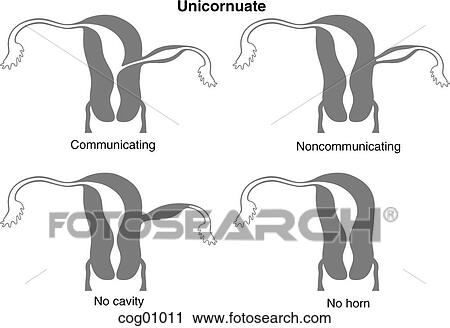 Clip Art - Mullerian duct anomaly, unicornuate. Fotosearch