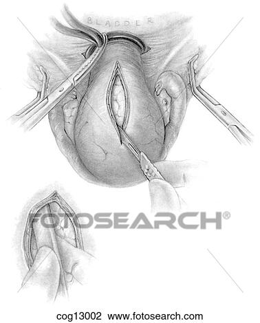Drawing - Myomectomy, controlling blood flow. Fotosearch