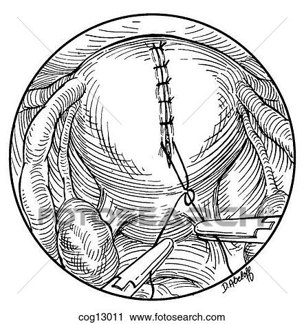 Myomectomy, uterine, laparoscopic, step 5 View Large Illustration Clip Art - Myomectomy, uterine, laparoscopic, step 5. Fotosearch