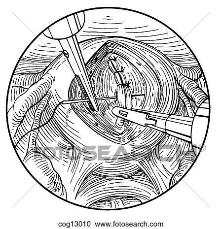 Myomectomy, uterine, laparoscopic, step 4 View Large Illustration Clipart - Myomectomy, uterine, laparoscopic, step 4. Fotosearch
