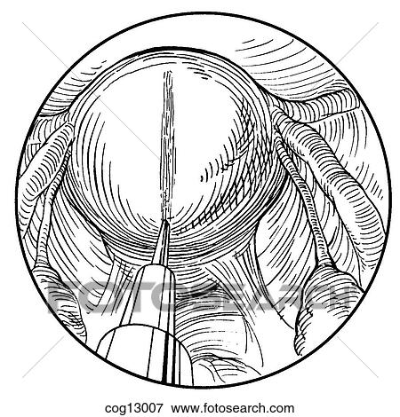 Stock Illustration - Myomectomy, uterine, laparoscopic, step 1. Fotosearch
