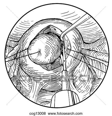 Myomectomy, uterine, laparoscopic, step 2 View Large Illustration Stock Illustration - Myomectomy, uterine, laparoscopic, step 2. Fotosearch