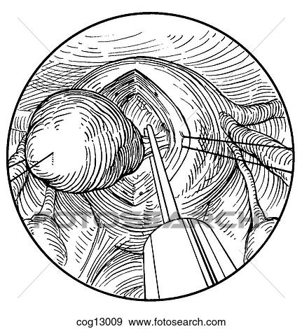 Myomectomy, uterine, laparoscopic, step 3 View Large Illustration Stock Illustration - Myomectomy, uterine, laparoscopic, step 3. Fotosearch