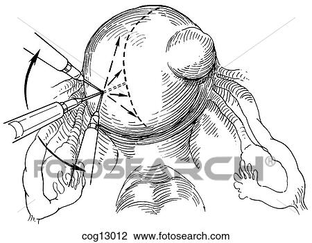 Myomectomy, uterine, step 1 View Large Illustration Drawing - Myomectomy, uterine, step 1. Fotosearch