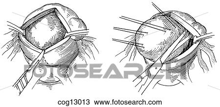 Myomectomy, uterine, step 2 View Large Illustration Drawing - Myomectomy, uterine, step 2. Fotosearch