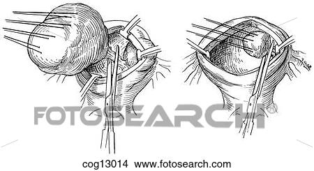 Stock Illustration - Myomectomy, uterine, step 3. Fotosearch