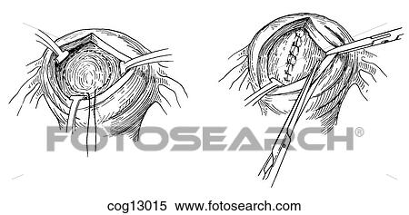 Myomectomy, uterine, step 4 View Large Illustration Stock Illustration - Myomectomy, uterine, step 4. Fotosearch
