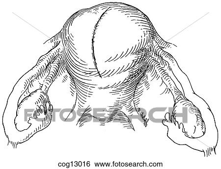 Myomectomy, uterine, step 5 View Large Illustration Stock Illustration - Myomectomy, uterine, step 5. Fotosearch