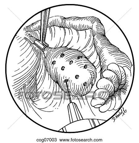 Ovary, polycystic View Large Illustration Drawing - Ovary, polycystic. Fotosearch