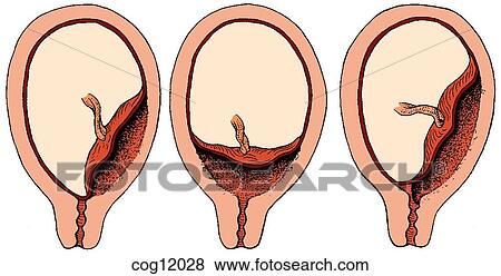 Placenta, previa View Large Illustration Stock Illustration - Placenta, previa. Fotosearch