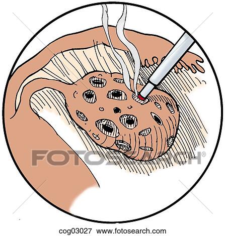 Polycystic ovaries, laser ablation View Large Illustration Stock Illustration - Polycystic ovaries, laser ablation. Fotosearch