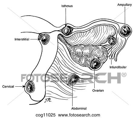 Stock Illustration - Pregnancy, ectopic. Fotosearch