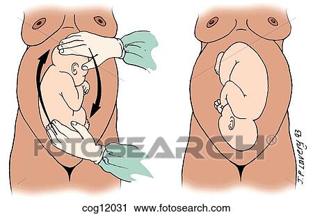 Clip Art - Presentation, breech, external cephalic version. Fotosearch