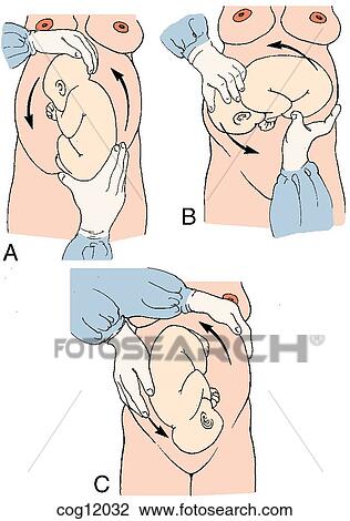 Drawing - Presentation, breech, external cephalic version. Fotosearch