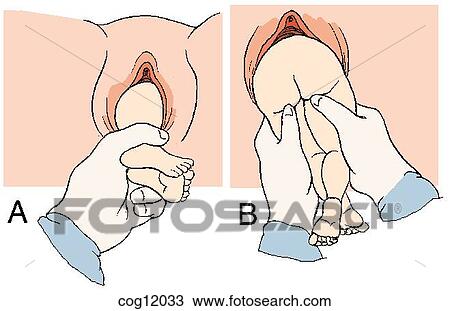 Presentation, breech, extraction, step 1 View Large Illustration Drawing - Presentation, breech, extraction, step 1. Fotosearch