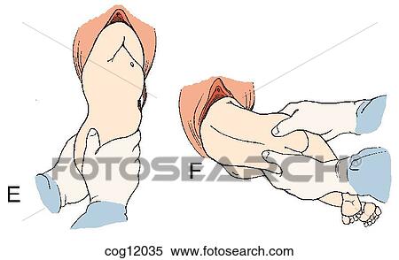 Presentation, breech, extraction, step 3 View Large Illustration Stock Illustration - Presentation, breech, extraction, step 3. Fotosearch