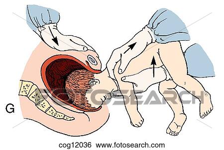Presentation, breech, extraction, step 4 View Large Illustration Stock Illustration - Presentation, breech, extraction, step 4. Fotosearch