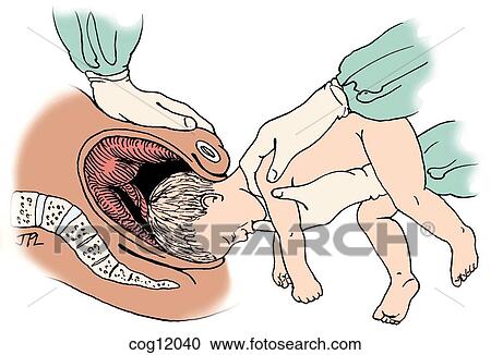 Presentation, breech, MSV maneuver View Large Illustration Clipart - Presentation, breech, MSV maneuver. Fotosearch
