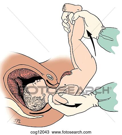 breech presentation with drawing