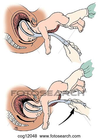 Stock Illustration - Presentation, vertex, Piper forceps. Fotosearch