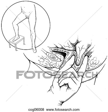 Stock Illustration - Rectovaginal examination, standing. Fotosearch