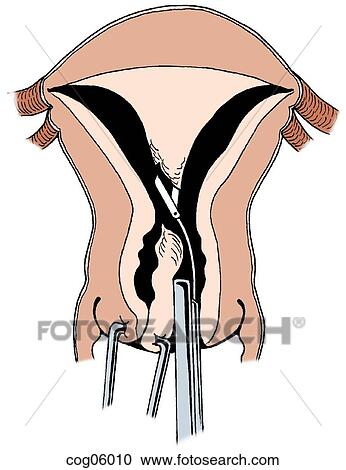 Clipart - Septate uterus, hysteroscopic division, step 2. Fotosearch