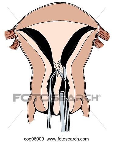 Septate uterus, hysteroscopic division, step 1 View Large Illustration Stock Illustration - Septate uterus, hysteroscopic division, step 1. Fotosearch