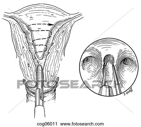 Septate uterus, hysteroscopic incision View Large Illustration Clip Art - Septate uterus, hysteroscopic incision. Fotosearch