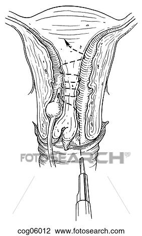 Septate uterus, hysteroscopic incision, t. 2, pt. 1 View Large Illustration Drawing - Septate uterus, hysteroscopic incision, t. 2, pt. 1. Fotosearch
