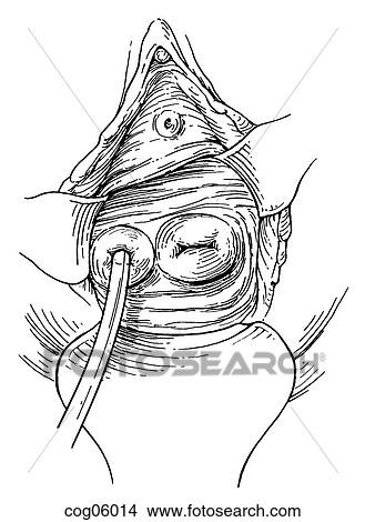 Septate uterus, hysteroscopic incision, t. 2, pt. 3 View Large Illustration Stock Illustration - Septate uterus, hysteroscopic incision, t. 2, pt. 3. Fotosearch
