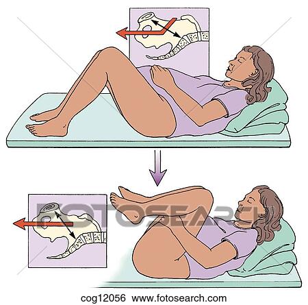 Stock Illustration - Shoulder dystocia, McRoberts maneuver. Fotosearch