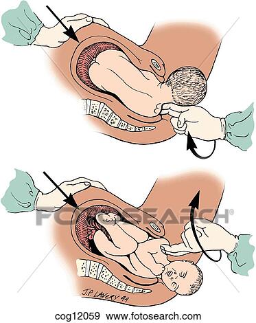 Shoulder dystocia, Woods corkscrew maneuver View Large Illustration Stock Illustration - Shoulder dystocia, Woods corkscrew maneuver. Fotosearch
