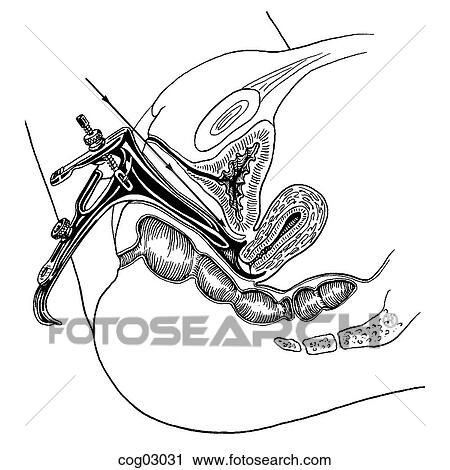 Clip Art - Speculum insertion. Fotosearch
